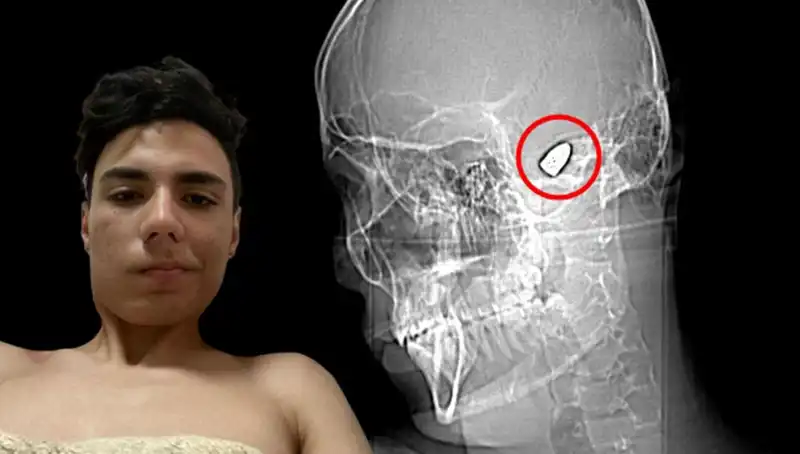 Kafasında Patlayıcı Bomba Taşıyan Genç: Hayatı Tehlikeye Girdi